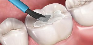 6 Reasons Dental Sealants are a Good Idea for your Teeth 1