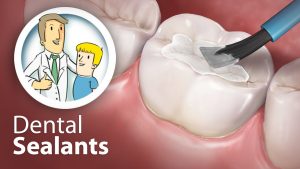 6 Reasons Dental Sealants are a Good Idea for your Teeth 2