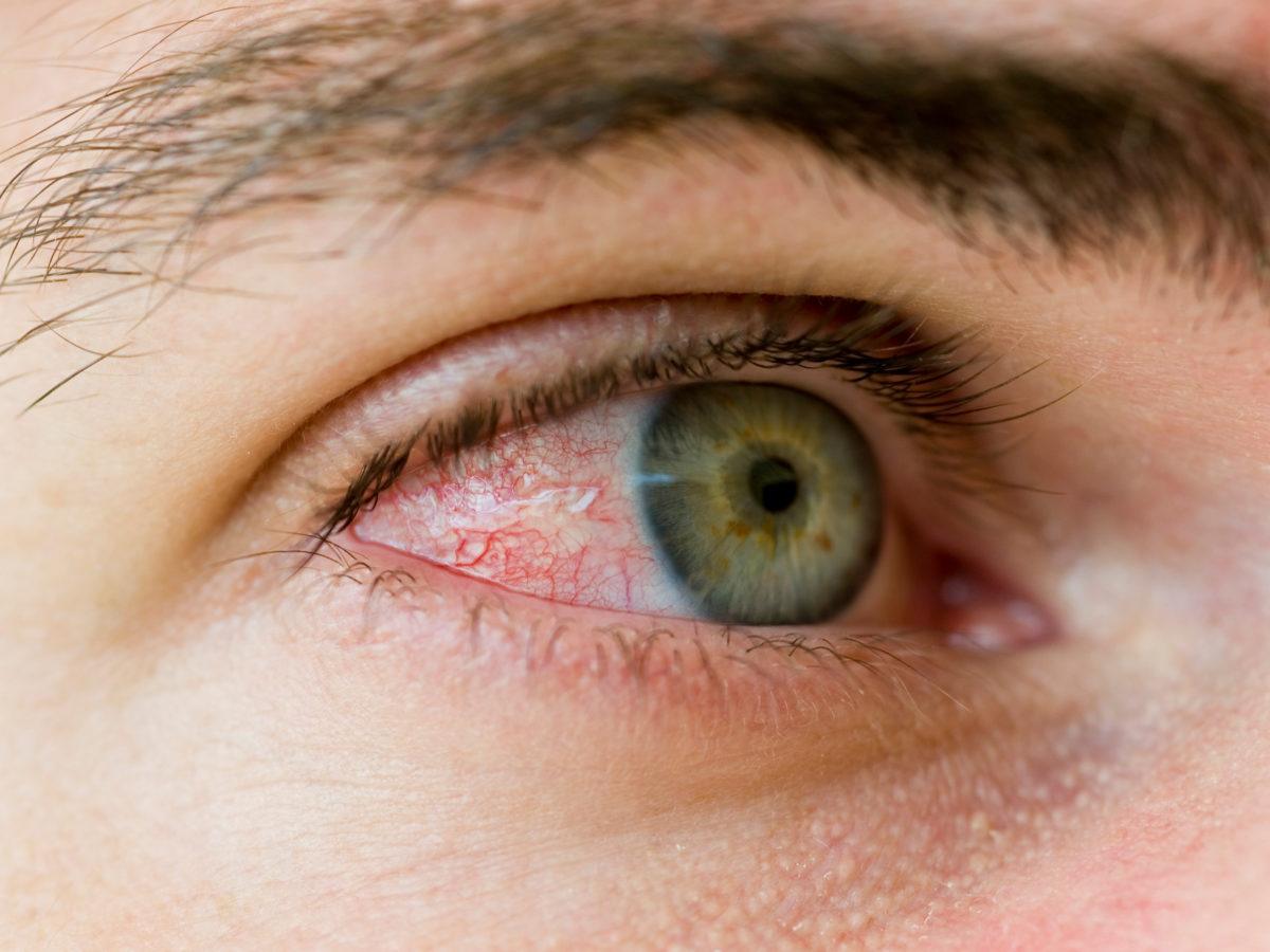 Top Home Remedies For Red Eyes