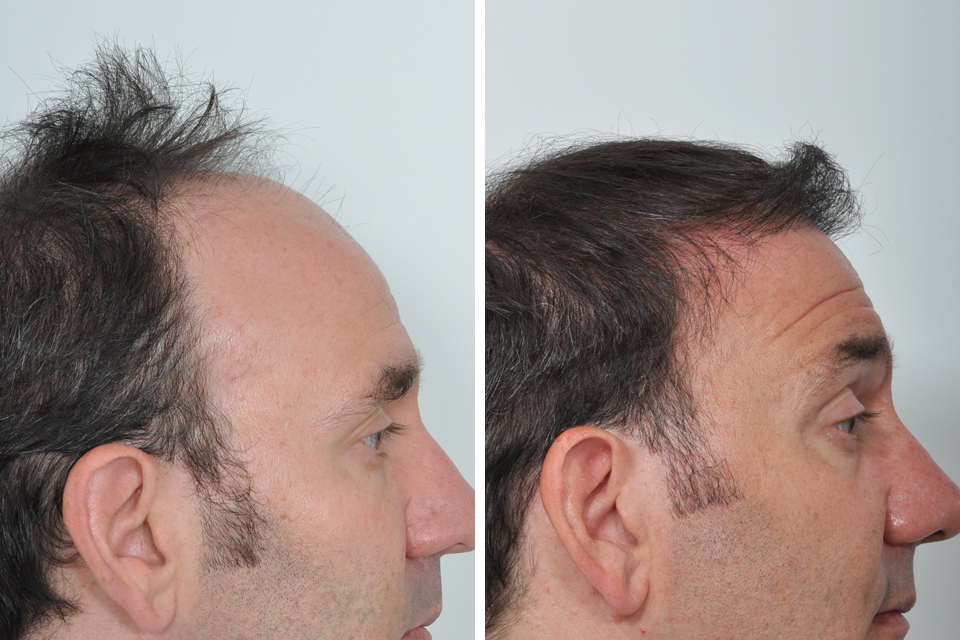 Suffering With Patch Baldness Get A Hair Transplant Easily
